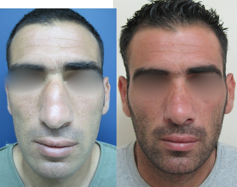 Dr. Gil Zeligson - Rhinoplasty
