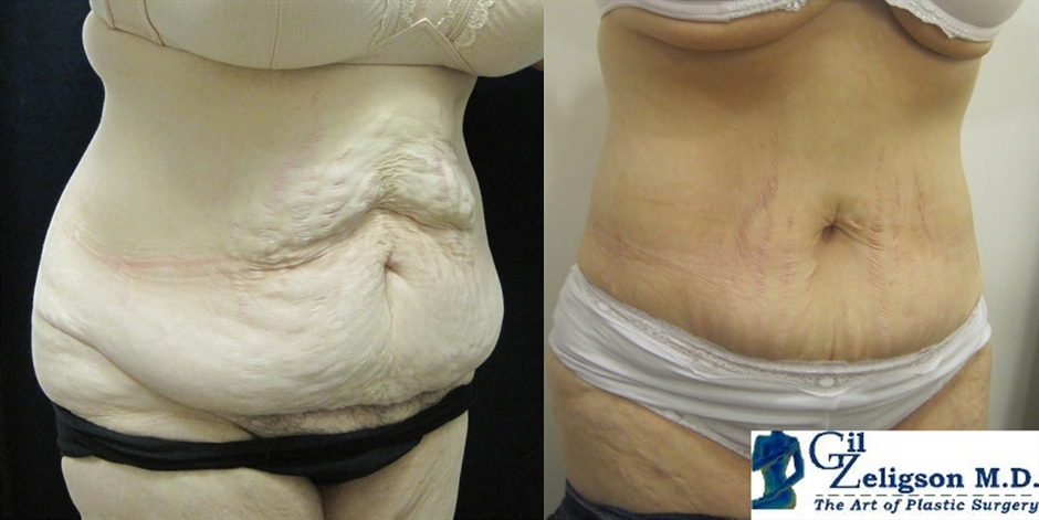 Dr. Gil Zeligson - Tummy Tuck Abdomino plasty