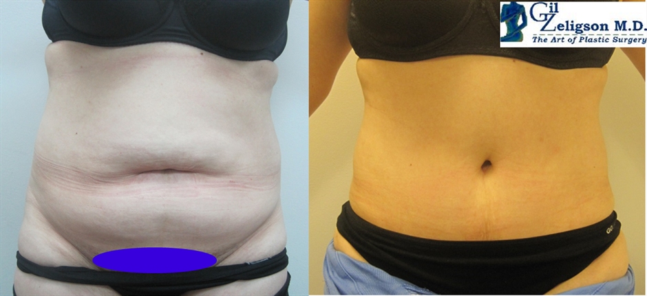 Dr. Gil Zeligson - Tummy Tuck Abdomino plasty