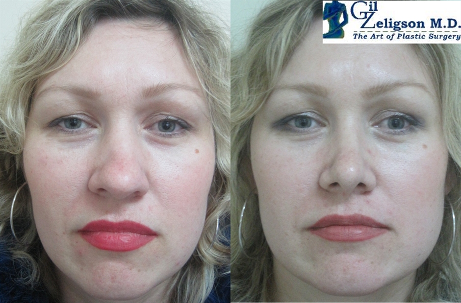 Dr. Gil Zeligson - Rhinoplasty