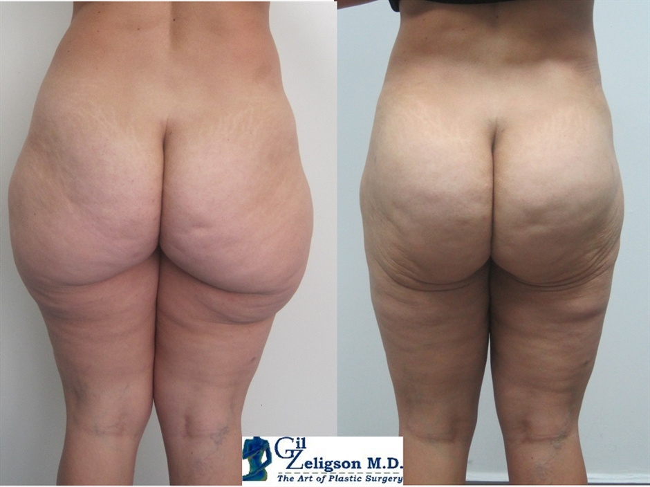 Dr. Gil Zeligson - Liposuction