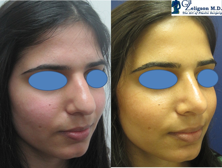 Dr. Gil Zeligson - Rhinoplasty