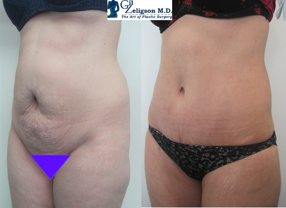 Dr. Gil Zeligson - Tummy Tuck Abdomino plasty