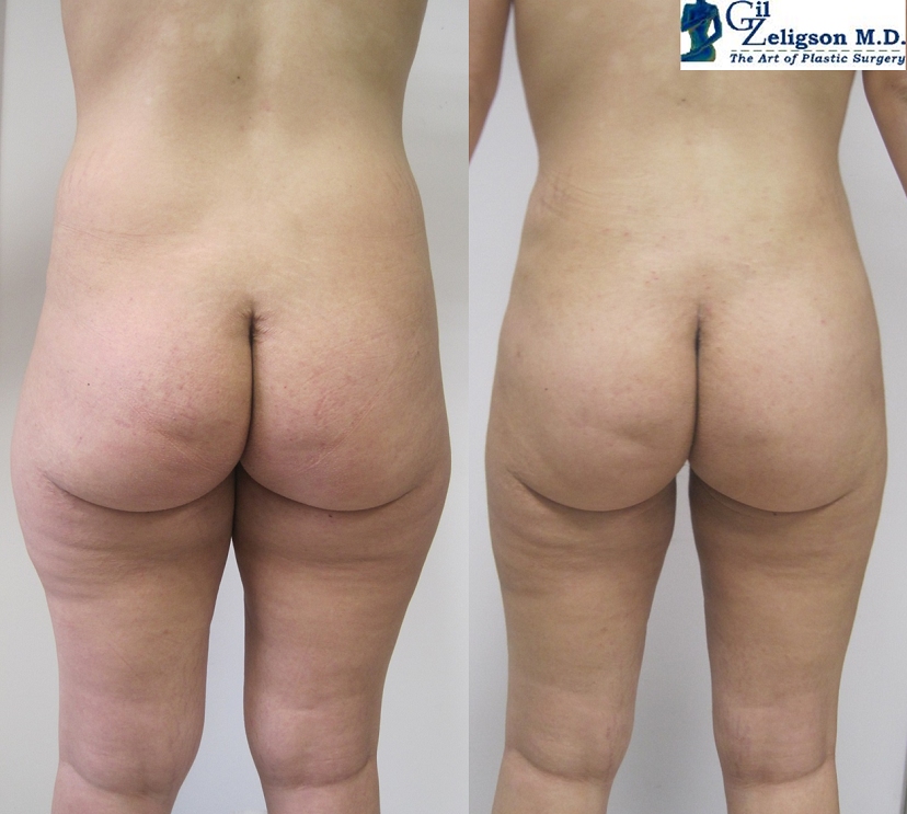 Dr. Gil Zeligson - Liposuction
