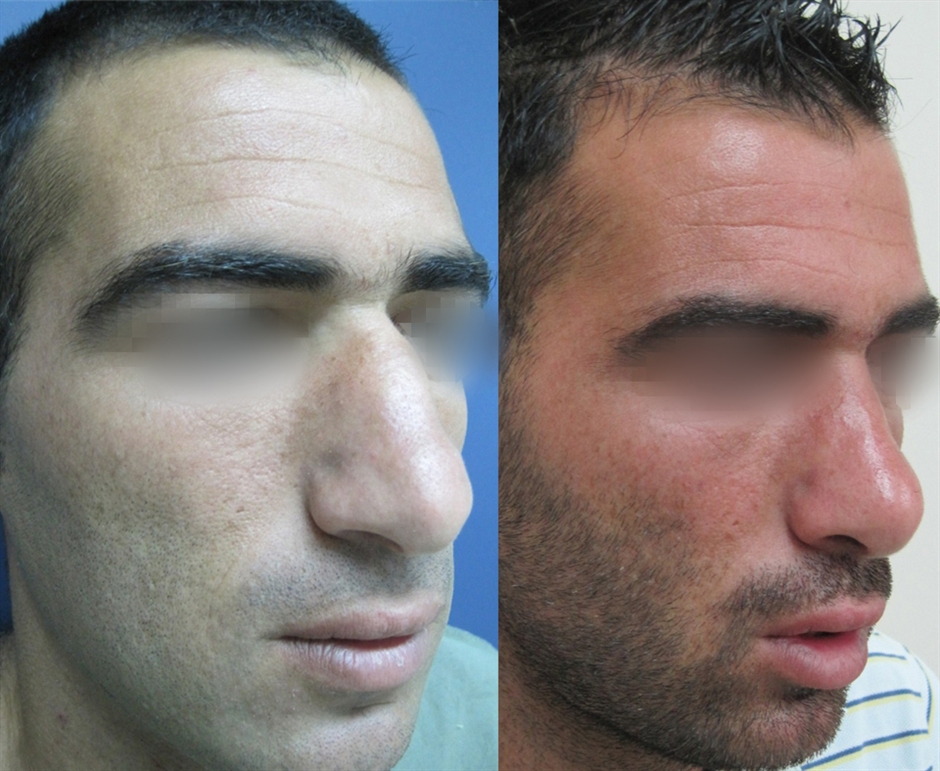 Dr. Gil Zeligson - Rhinoplasty