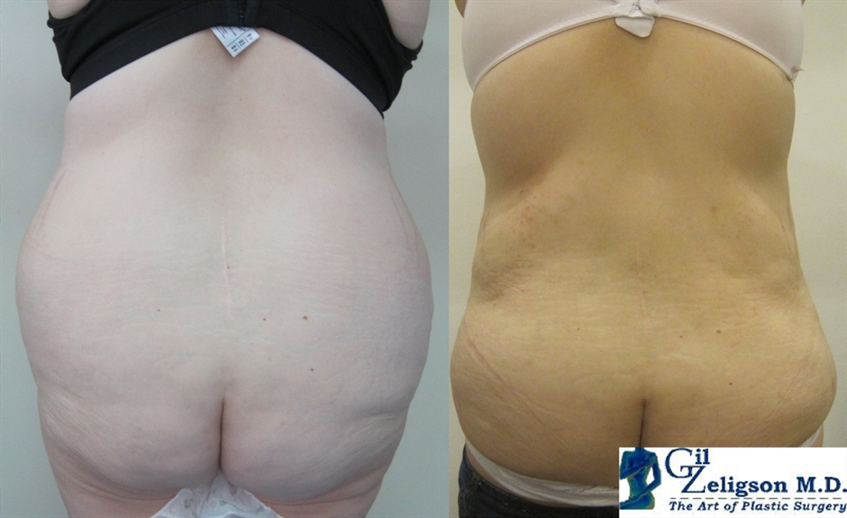 Dr. Gil Zeligson - Liposuction