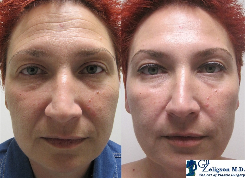 Dr. Gil Zeligson - Facial Sculpturing Hyaluronic acid