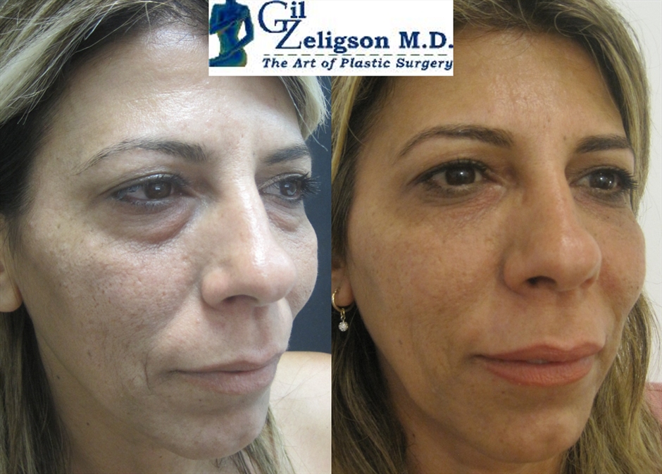 Dr. Gil Zeligson - Facial Sculpturing Hyaluronic acid