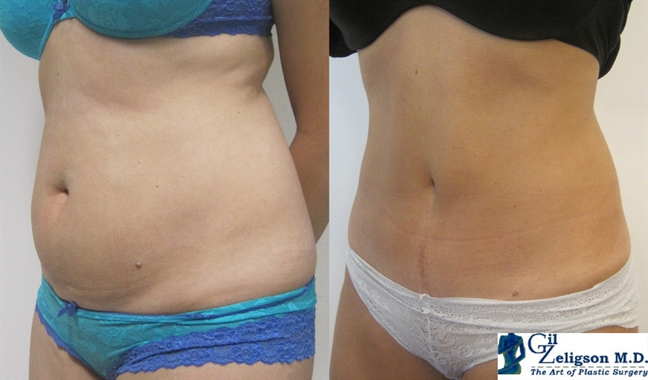 Dr. Gil Zeligson - Tummy Tuck Abdomino plasty
