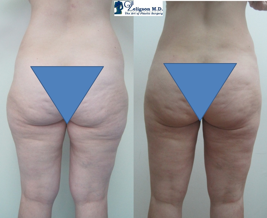 Dr. Gil Zeligson - Liposuction