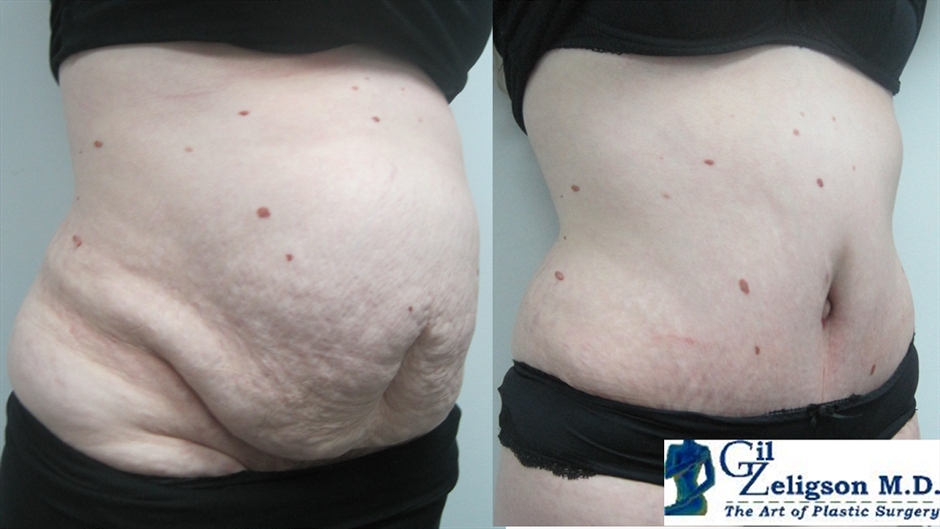Dr. Gil Zeligson - Tummy Tuck Abdomino plasty