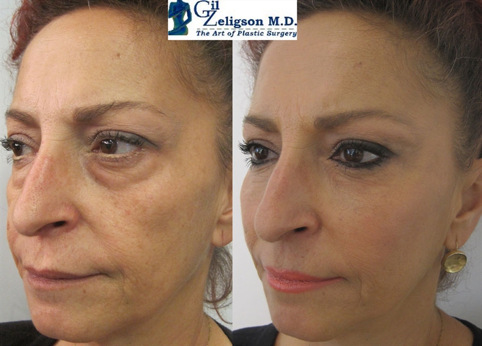 Facial Sculpturing Hyaluronic acid