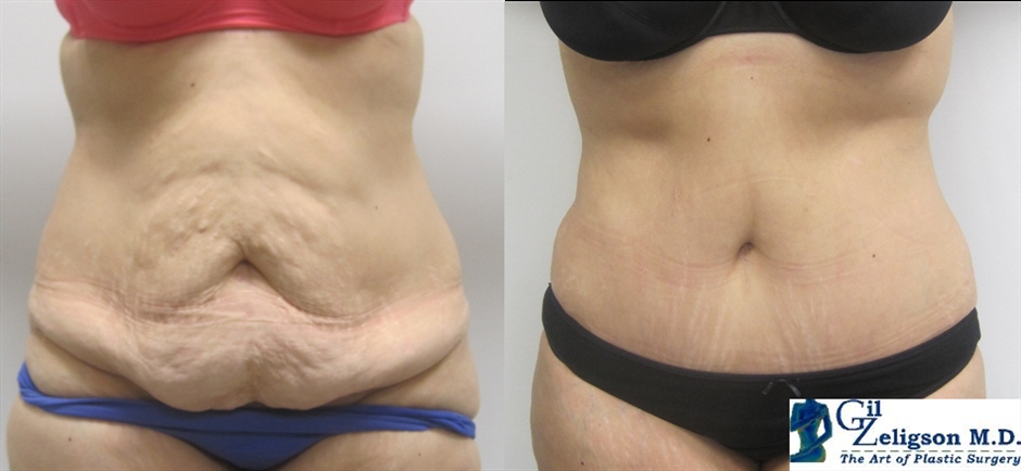Dr. Gil Zeligson - Tummy Tuck Abdomino plasty