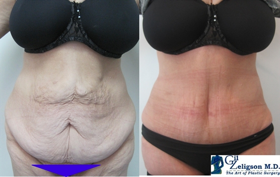 Dr. Gil Zeligson - Tummy Tuck Abdomino plasty