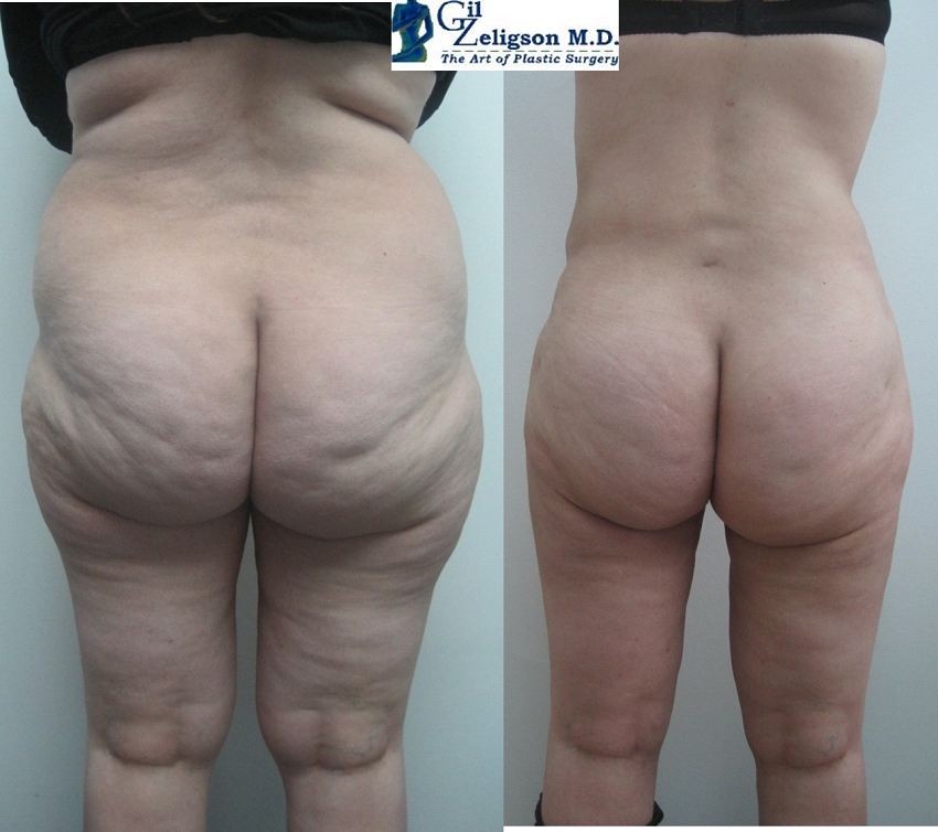 Dr. Gil Zeligson - Liposuction