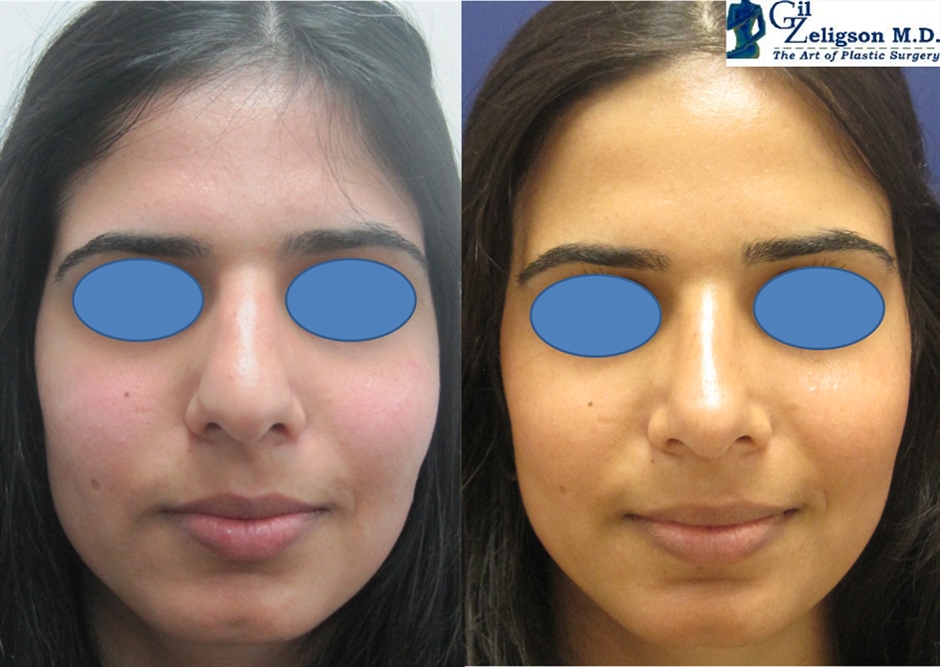 Dr. Gil Zeligson - Rhinoplasty