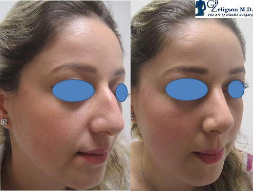 Dr. Gil Zeligson - Rhinoplasty