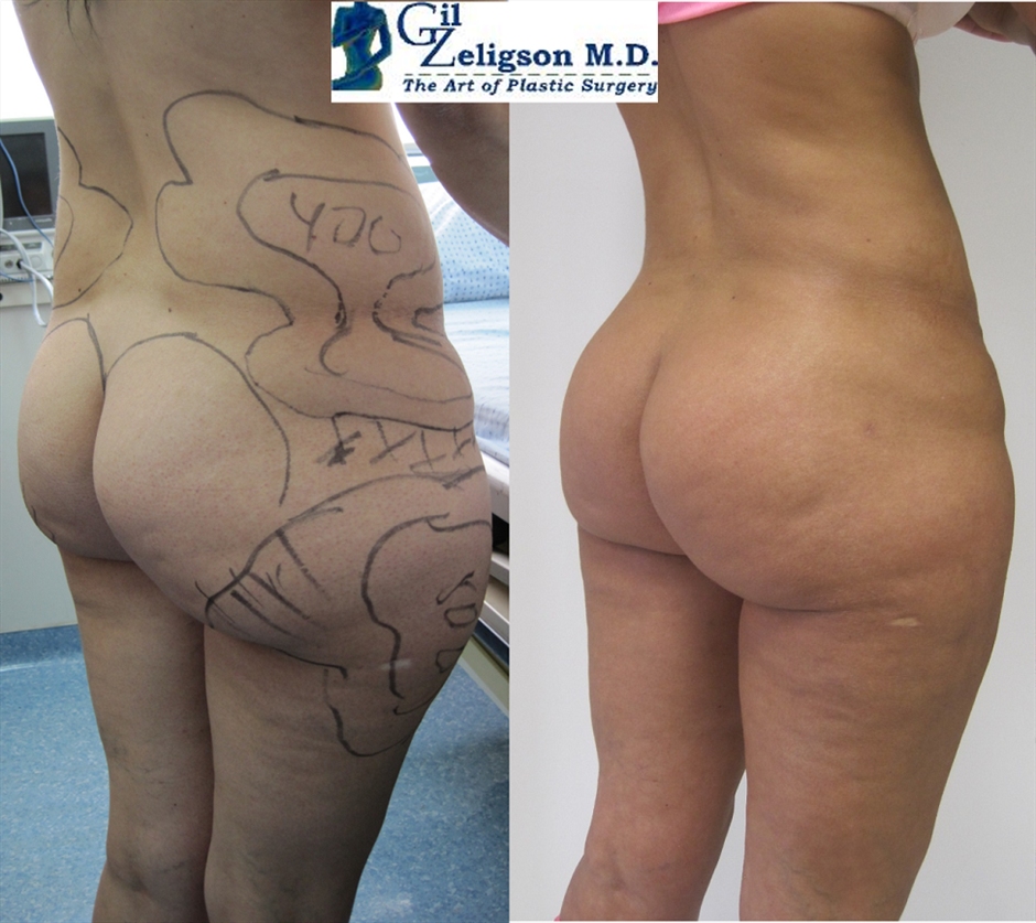 Dr. Gil Zeligson - Liposuction