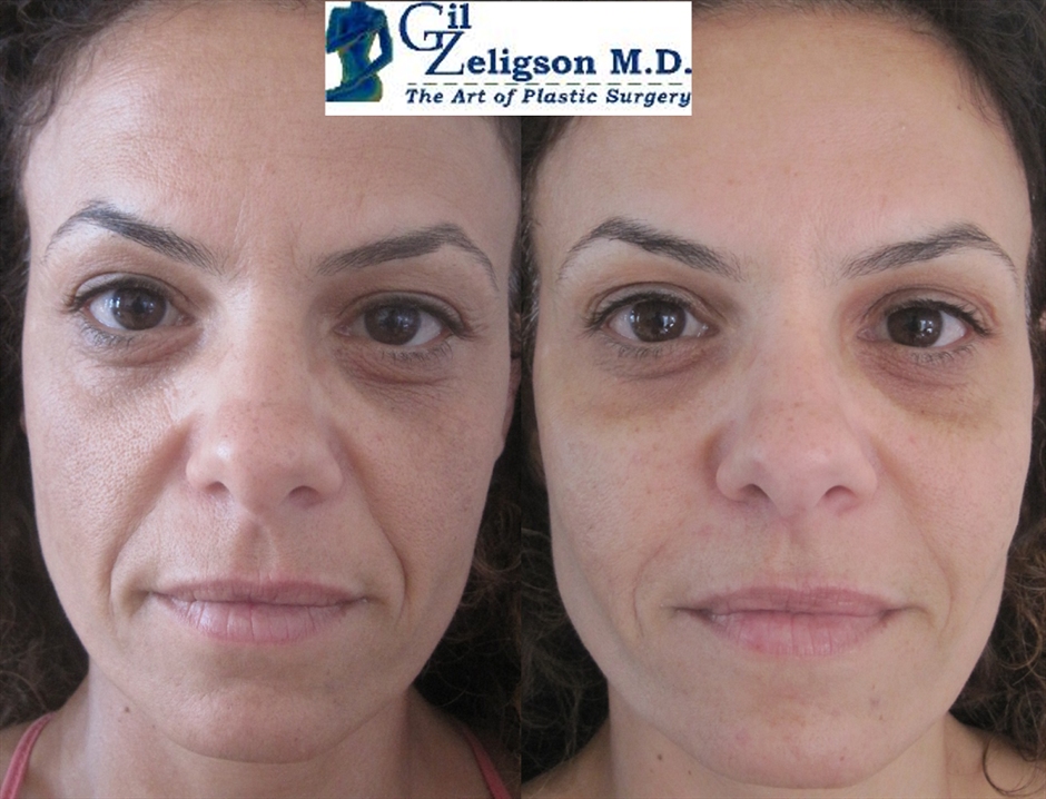 Dr. Gil Zeligson - Facial Sculpturing Hyaluronic acid