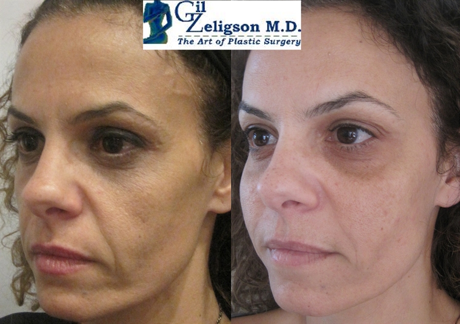 Dr. Gil Zeligson - Facial Sculpturing Hyaluronic acid