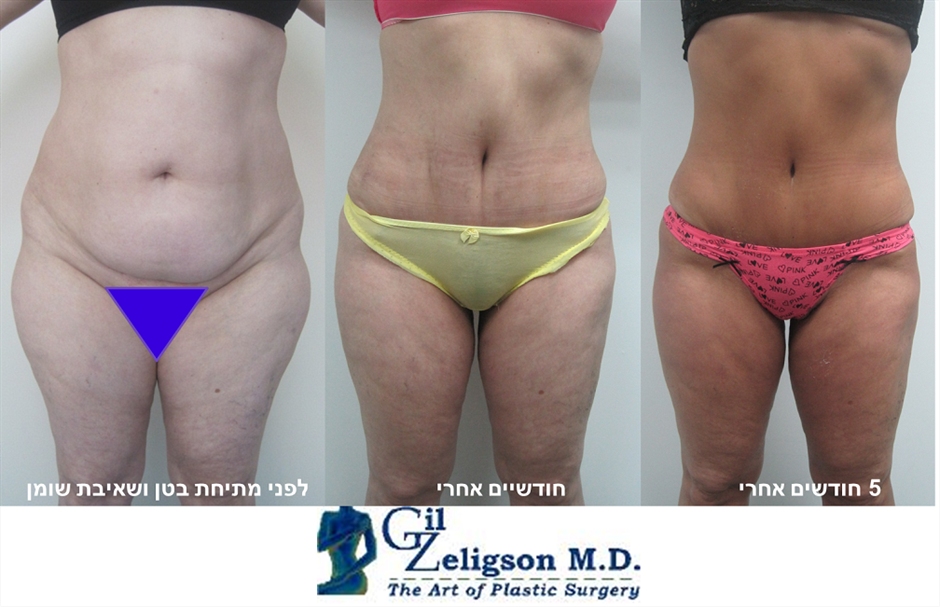 Dr. Gil Zeligson - Tummy Tuck Abdomino plasty