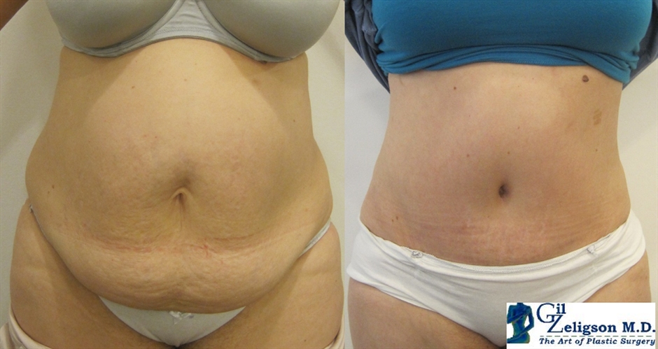 Dr. Gil Zeligson - Tummy Tuck Abdomino plasty