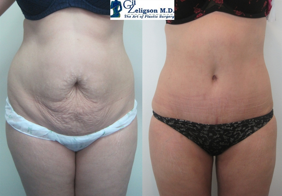 Dr. Gil Zeligson - Tummy Tuck Abdomino plasty