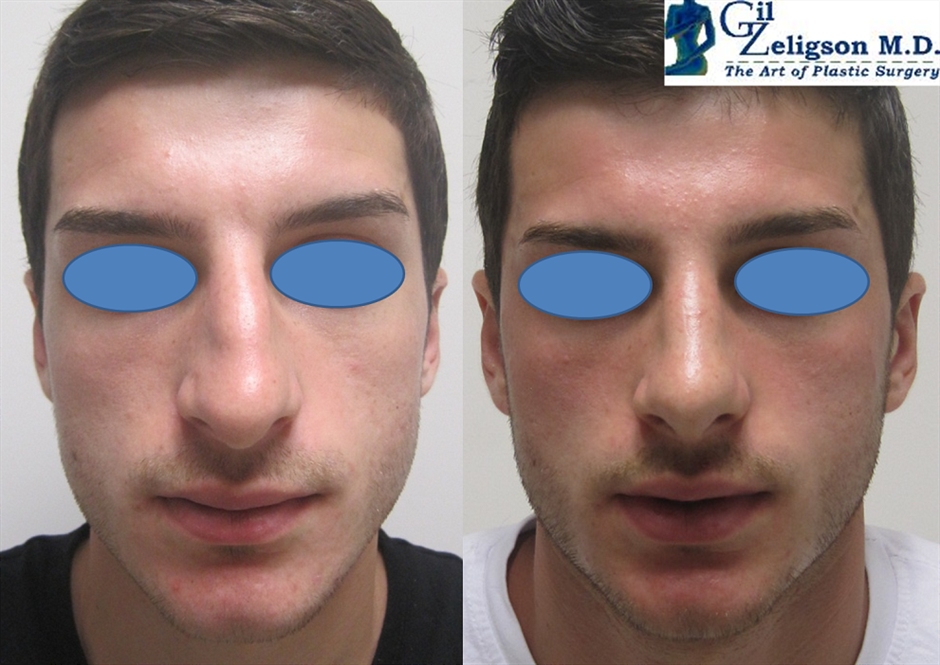 Dr. Gil Zeligson - Rhinoplasty