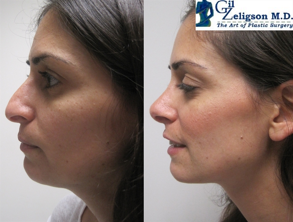 Dr. Gil Zeligson - Rhinoplasty