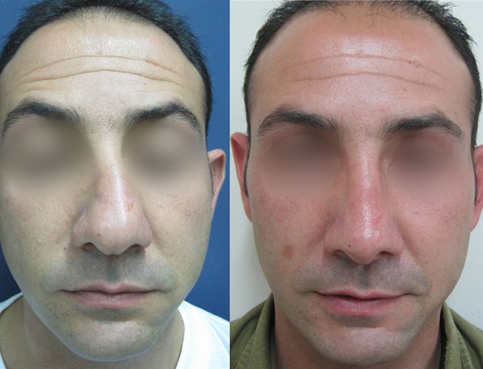 Dr. Gil Zeligson - Rhinoplasty