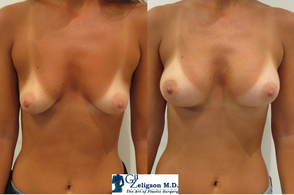 Dr. Gil Zeligson - Breast augmentation