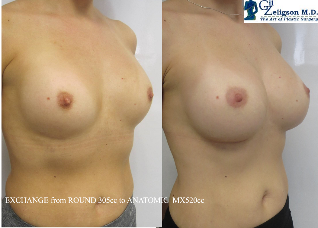 Dr. Gil Zeligson - Breast augmentation