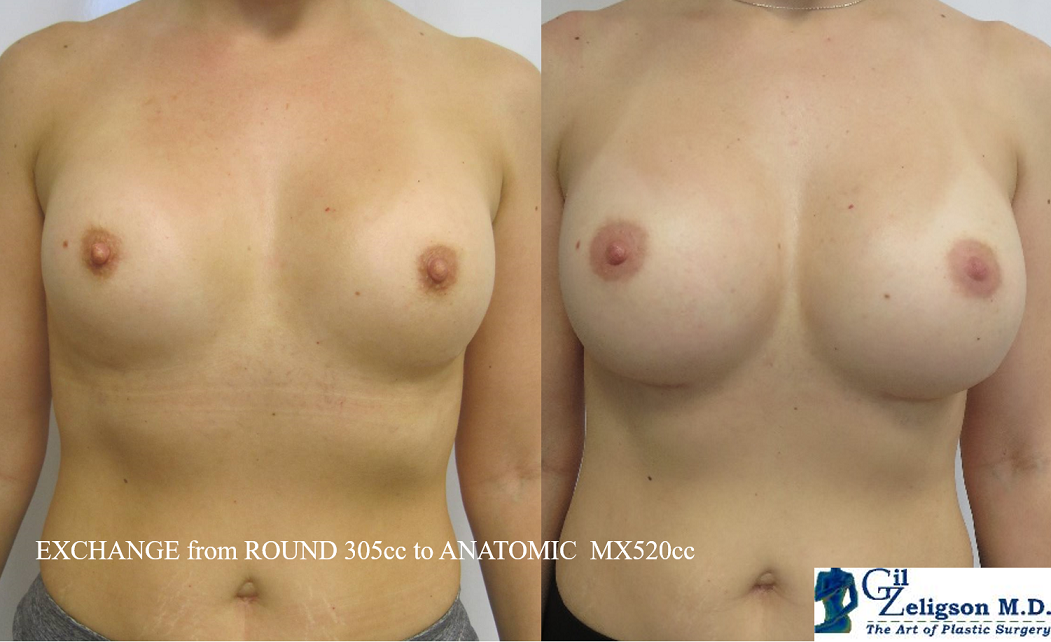 Dr. Gil Zeligson - Breast augmentation
