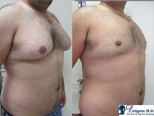 Dr. Gil Zeligson - Liposuction