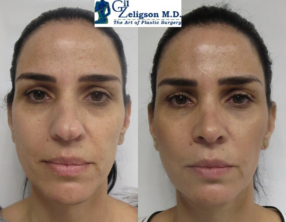 Dr. Gil Zeligson - Rhinoplasty