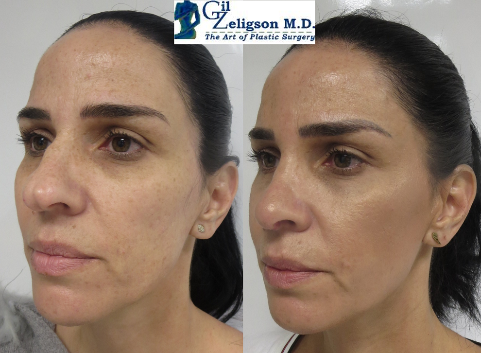 Dr. Gil Zeligson - Rhinoplasty