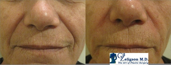 Dr. Gil Zeligson - Lips augmentaion & Wrinkles filling