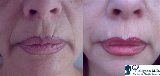 Dr. Gil Zeligson - Lips augmentaion & Wrinkles filling