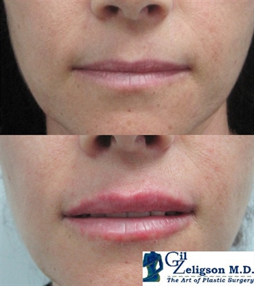 Dr. Gil Zeligson - Lips augmentaion & Wrinkles filling