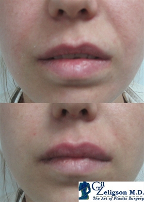 Dr. Gil Zeligson - Lips augmentaion & Wrinkles filling