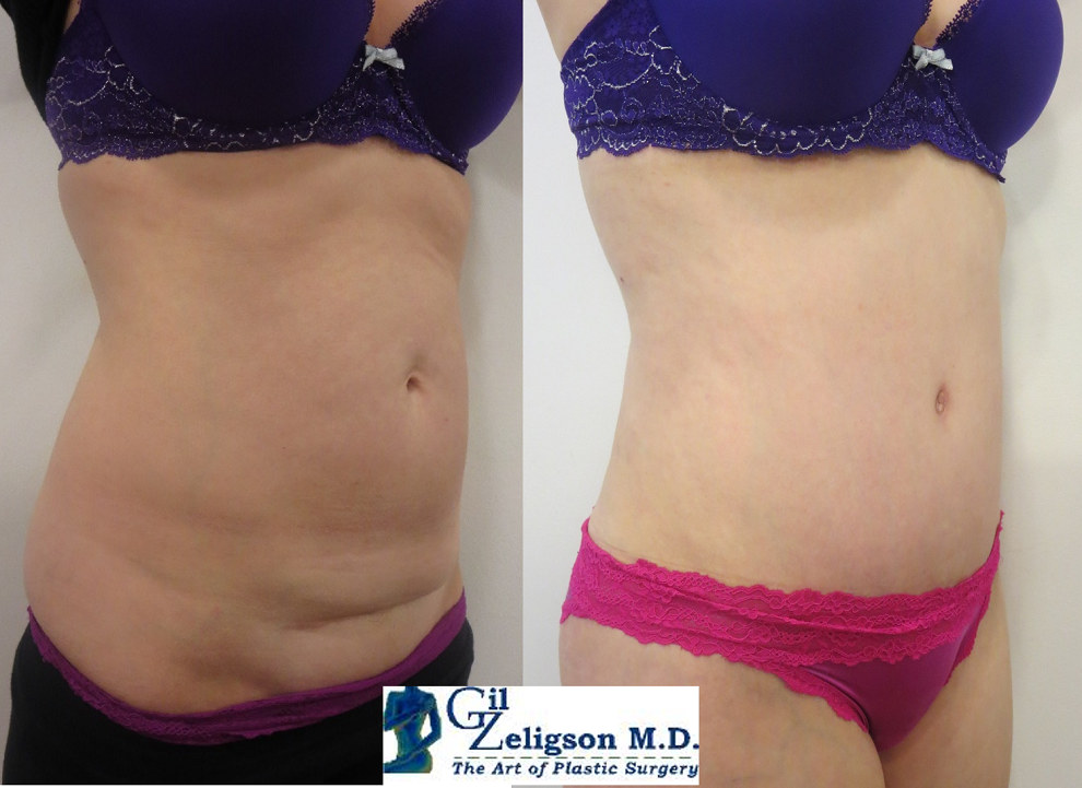 Dr. Gil Zeligson - Tummy Tuck Abdomino plasty