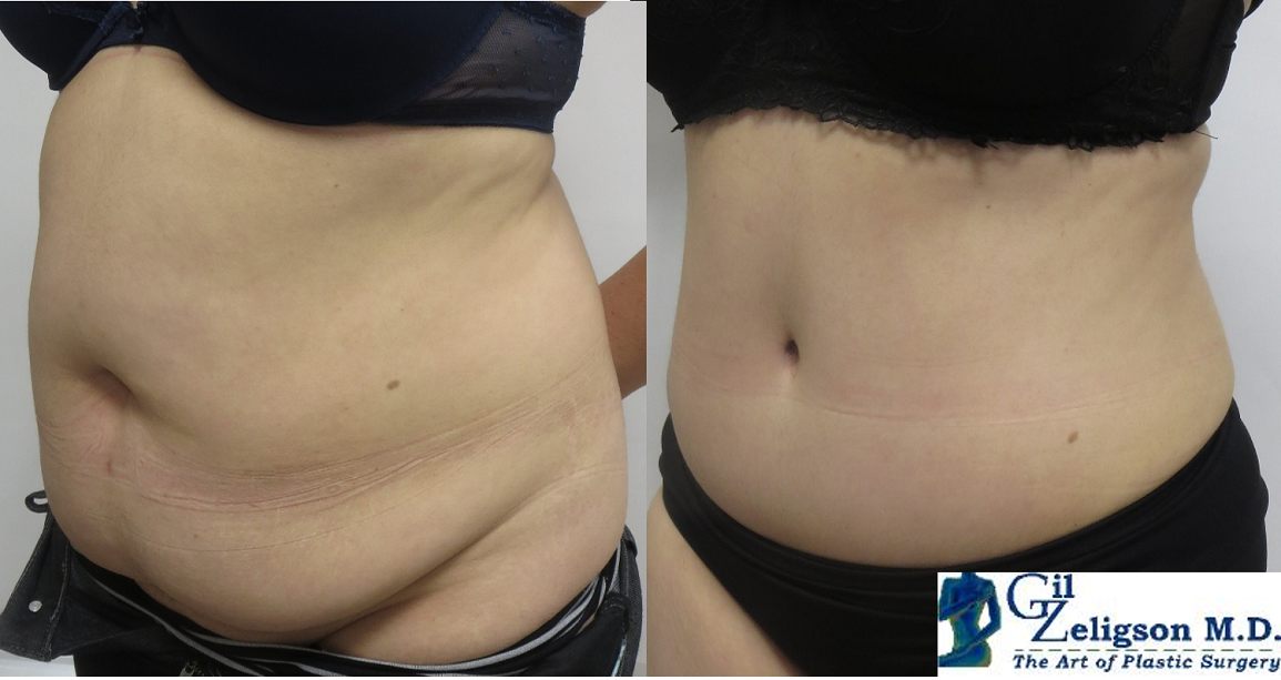 Dr. Gil Zeligson - Tummy Tuck Abdomino plasty