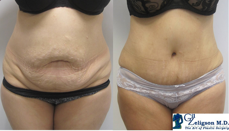 Dr. Gil Zeligson - Tummy Tuck Abdomino plasty