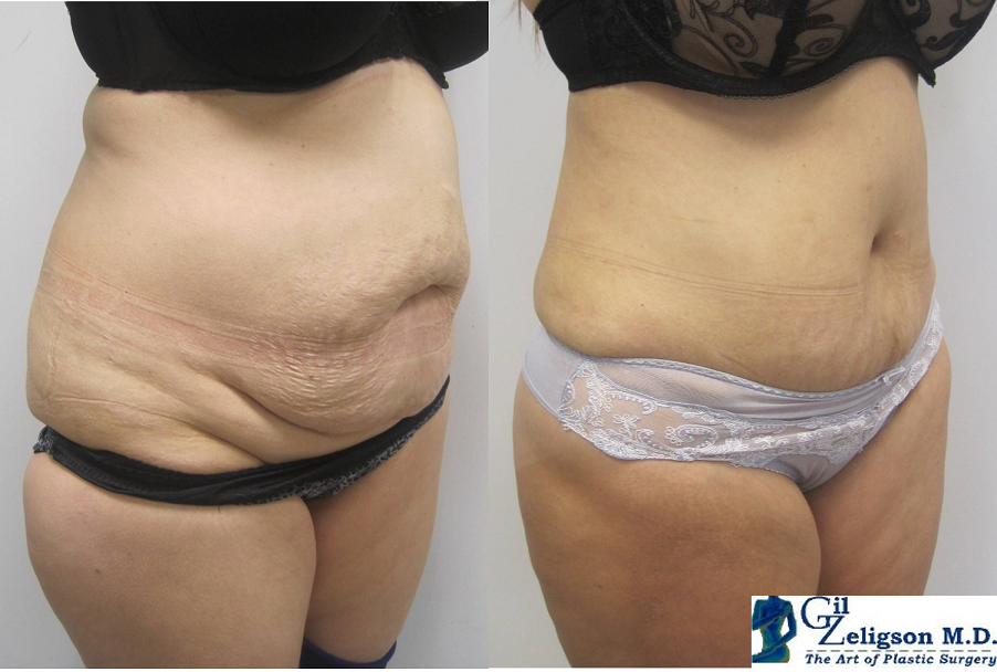 Dr. Gil Zeligson - Tummy Tuck Abdomino plasty