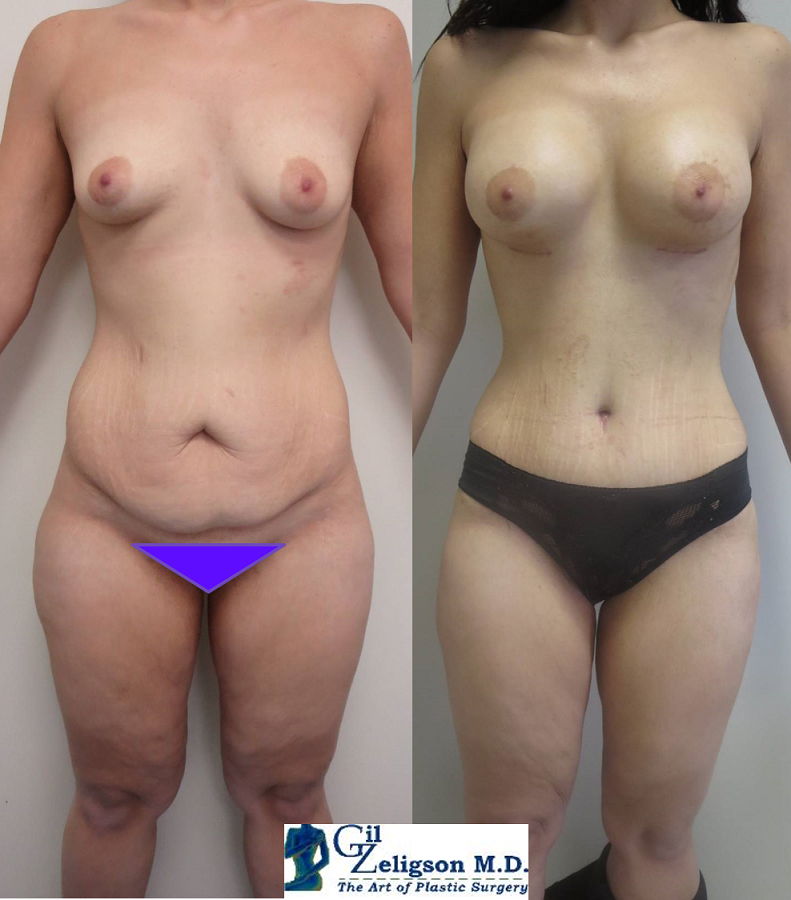 Dr. Gil Zeligson - Tummy Tuck Abdomino plasty