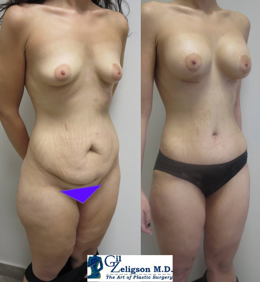 Dr. Gil Zeligson - Tummy Tuck Abdomino plasty