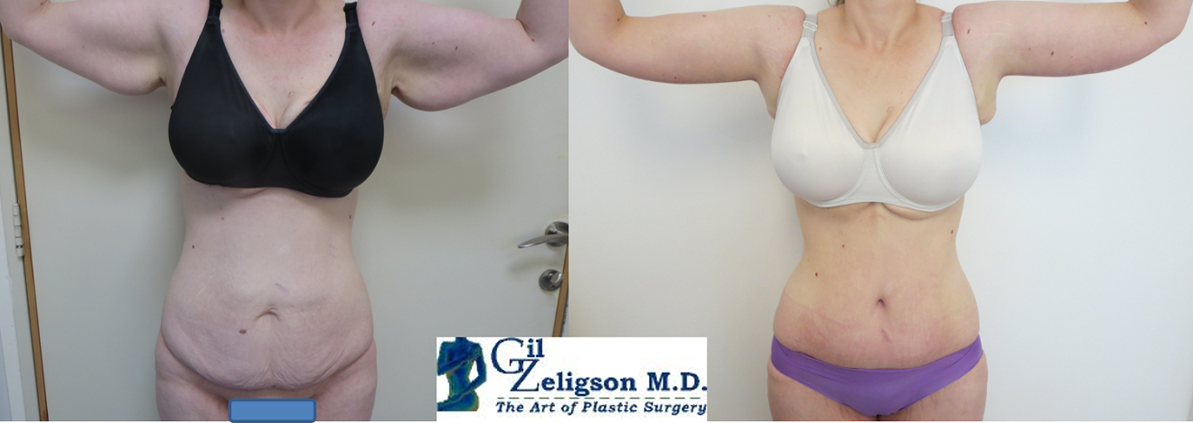 Dr. Gil Zeligson - Tummy Tuck Abdomino plasty