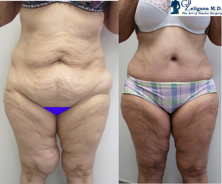 Dr. Gil Zeligson - Tummy Tuck Abdomino plasty