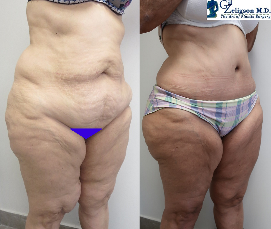 Dr. Gil Zeligson - Tummy Tuck Abdomino plasty