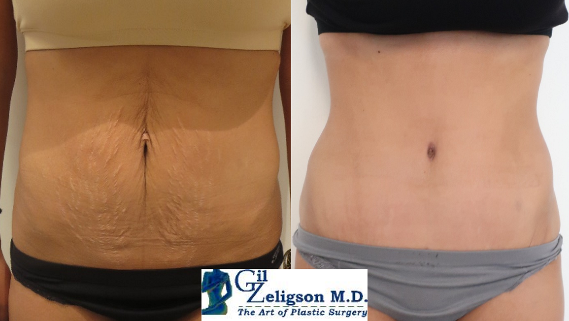 Dr. Gil Zeligson - Tummy Tuck Abdomino plasty